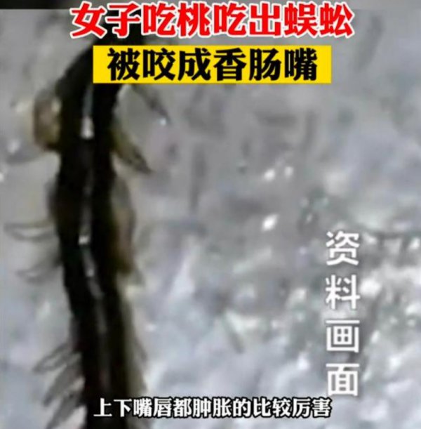 本日健康 | 江苏一女子吃桃吃出蜈蚣被咬成腊肠嘴，当事蜈蚣：“是她先动的口”